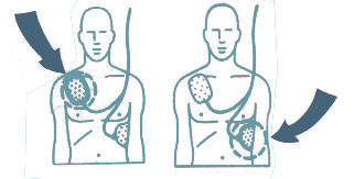 Defib electrode placement