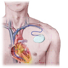 Implantable cardiac defibrillator