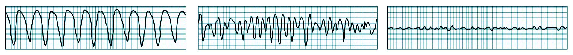 VT strip - CVF strip - FVF strip