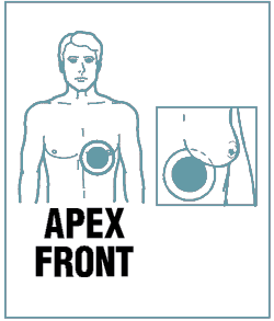 Anterior placement